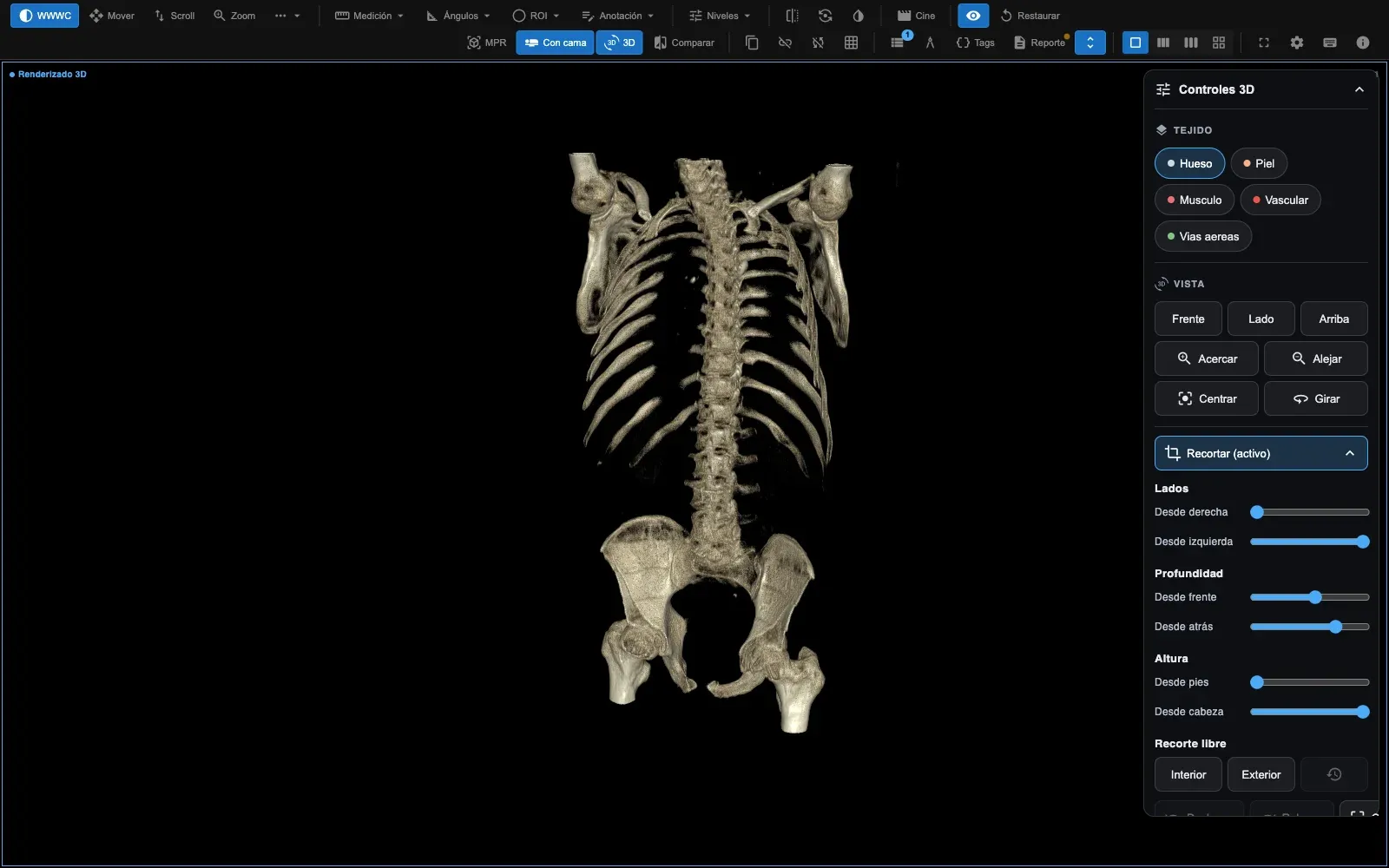 Reconstrucción 3D con el preset de hueso y la caja de recorte activa: se retiró la parrilla costal anterior y la camilla para dejar a la vista la columna y la pelvis
